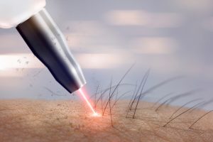 jak wybrac laser biznes laserowy magdalena atta-motte